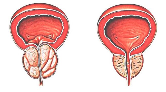 Prostatite et prostate normale. 