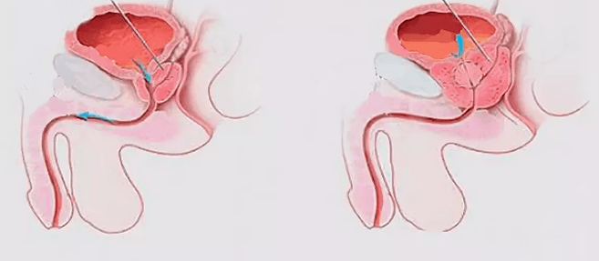 Signes de prostatite pour hommes