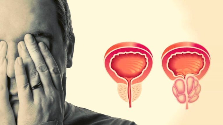Un homme a une prostatite