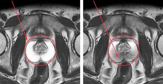 Prostate normale (à gauche) et inflammation de la prostate avec prostatite (à droite)